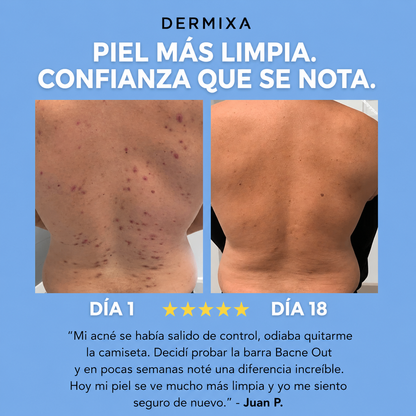 Dermixa™ Acne Bar