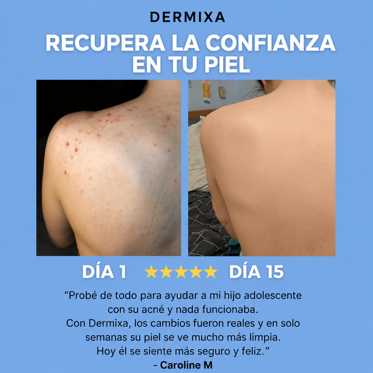 Dermixa™ Acne Bar